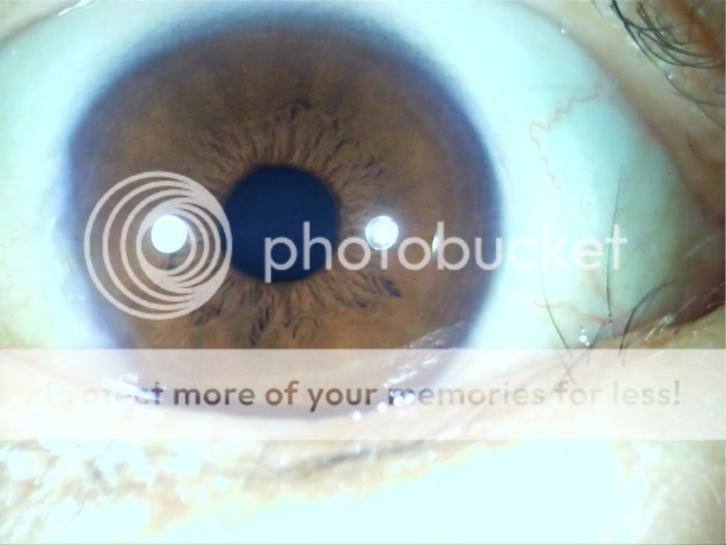 0M Iriscope/Iridology eye(Support hai/skin lens) with software